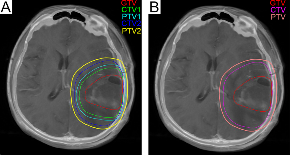 (A) The green line represents CTV1 in the radiation treatment planning in our center, and 204.6 cm3 was exposed to a dose of 60 Gy. (B) The fuchsia contour represents the CTV in th