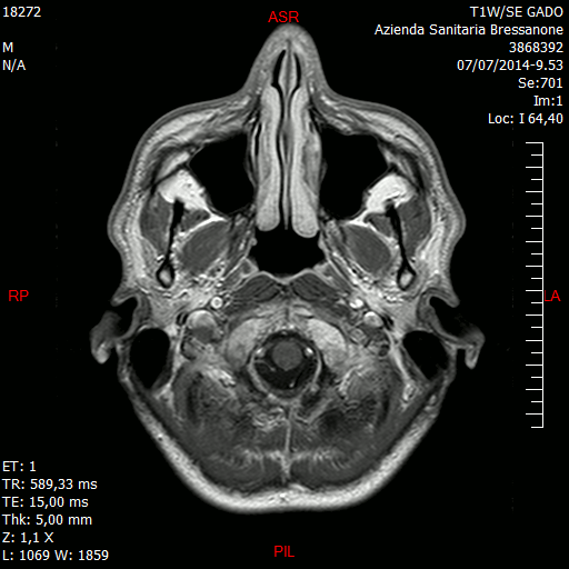 RM glioblastoma